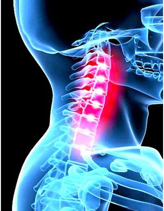 Klinična slika osteohondroze